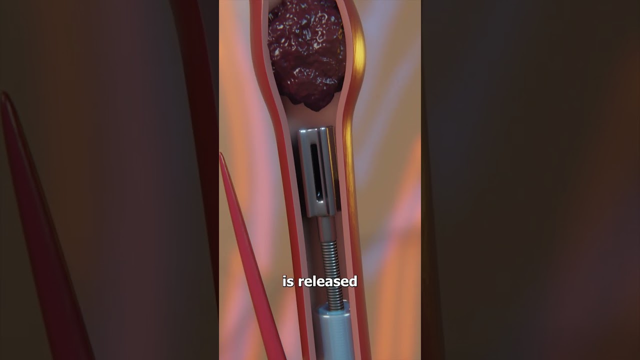 Milli-Spinner 的工作原理-咕咕的工具箱