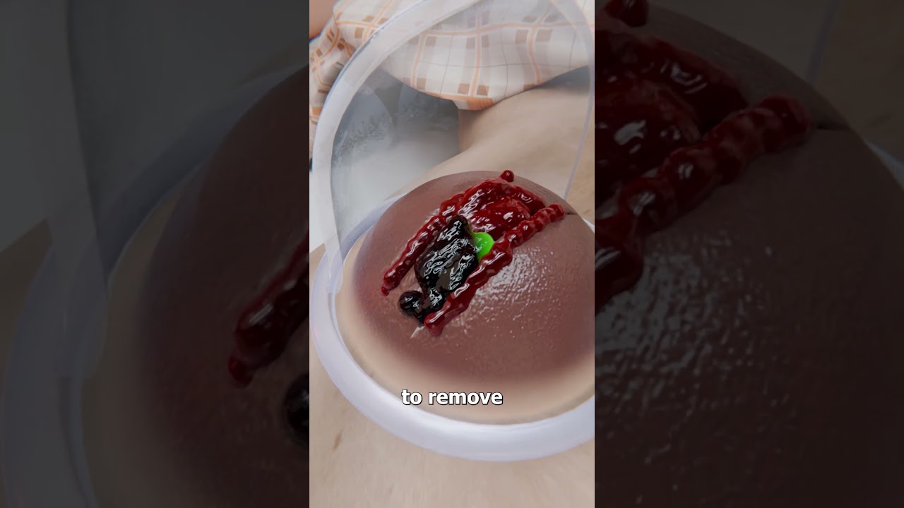 吸盘疗法的原理是什么-咕咕的工具箱