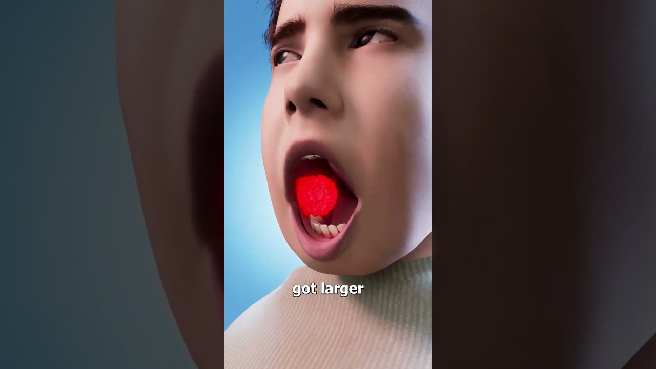 男孩下颌肿瘤长出500多颗牙齿